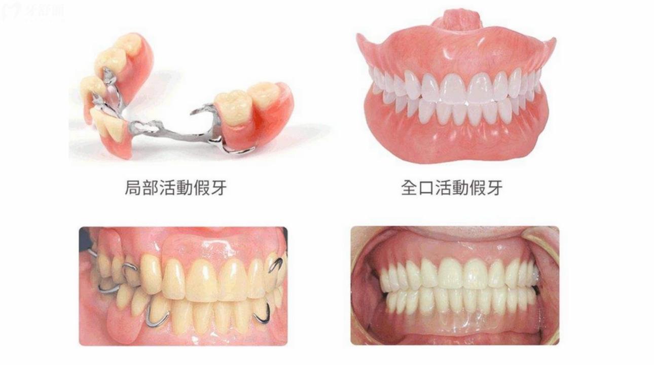 无挂钩假牙种类及图片 无挂钩假牙怎么固定的? 无挂钩假牙种类及图片 无挂钩假牙怎么固定的?