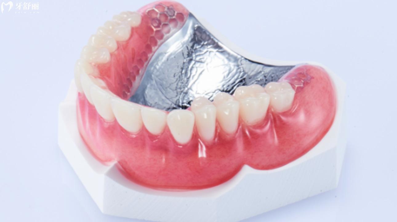 无挂钩假牙种类及图片 无挂钩假牙怎么固定的? 无挂钩假牙种类及图片 无挂钩假牙怎么固定的?