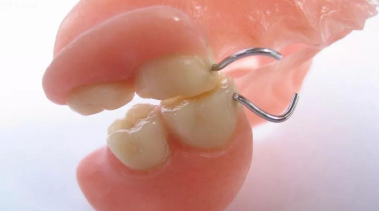 无挂钩假牙种类及图片 无挂钩假牙怎么固定的? 无挂钩假牙种类及图片 无挂钩假牙怎么固定的?