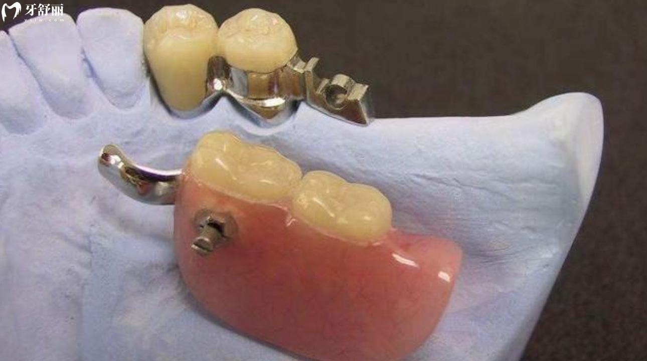 无挂钩假牙种类及图片 无挂钩假牙怎么固定的? 无挂钩假牙种类及图片 无挂钩假牙怎么固定的?