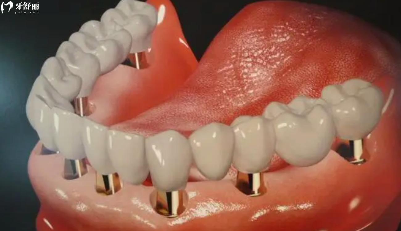 镶牙多少钱一颗.jpg 镶牙多少钱一颗.jpg