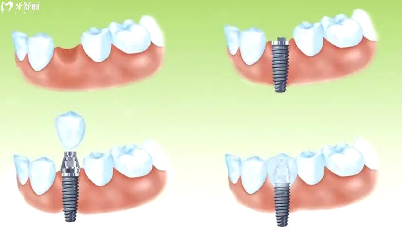 镶牙多少钱一颗.jpg 镶牙多少钱一颗.jpg