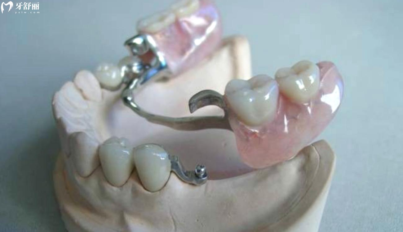 镶牙多少钱一颗.jpg 镶牙多少钱一颗.jpg