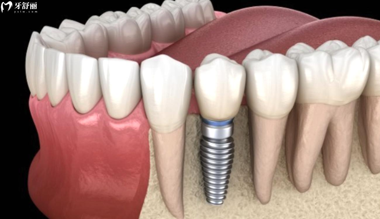 镶牙多少钱一颗.jpg 镶牙多少钱一颗.jpg