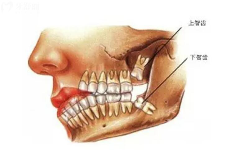 拔智齿一般费用多少钱 拔智齿一般费用多少钱