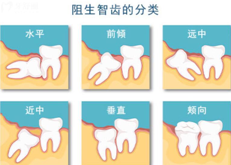 拔智齿一般费用多少钱 拔智齿一般费用多少钱