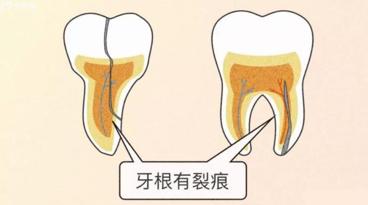 牙隐裂不治疗能坚持多久?牙隐裂疼痛为什么医生不治疗?