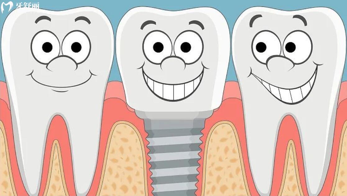 掉了一颗牙是种植好还是镶牙好呢?优缺点对比后让我不再犹豫 掉了一颗牙是种植好还是镶牙好呢?优缺点对比后让我不再犹豫