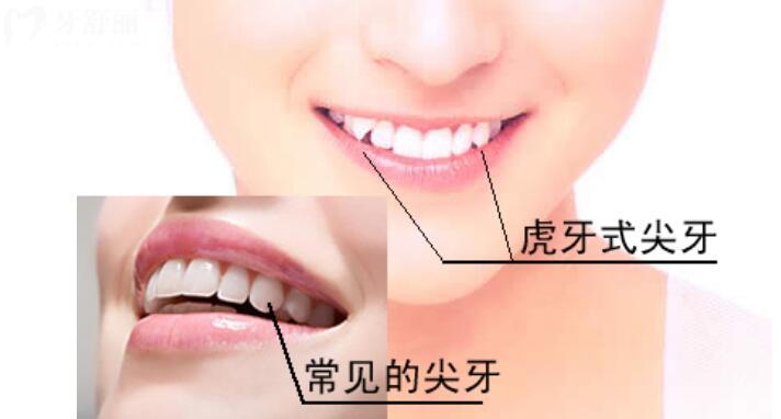 虎牙矫正会改变脸型吗 虎牙矫正会改变脸型吗