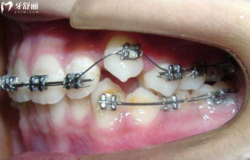 虎牙矫正会改变脸型吗 虎牙矫正会改变脸型吗