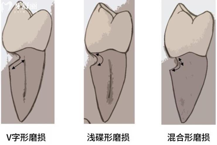 刷牙也会导致牙齿缺损?!楔形缺损的原因以及解决方法 刷牙也会导致牙齿缺损?!楔形缺损的原因以及解决方法