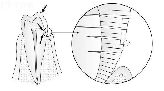 刷牙也会导致牙齿缺损?!楔形缺损的原因以及解决方法 刷牙也会导致牙齿缺损?!楔形缺损的原因以及解决方法