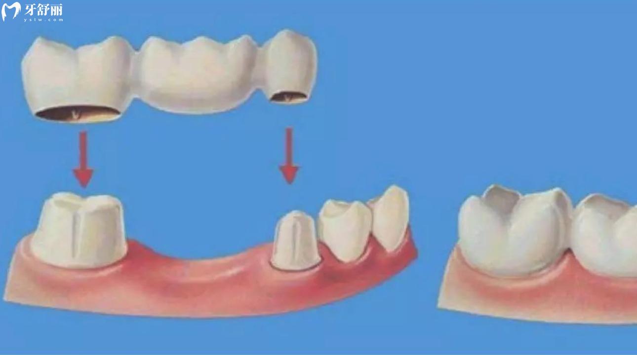 粘结桥牙齿多少钱一颗?粘结桥牙齿优缺点? 粘结桥牙齿多少钱一颗?粘结桥牙齿优缺点?