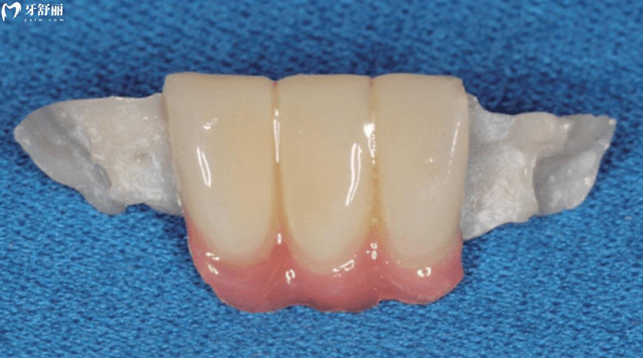 粘结桥牙齿多少钱一颗?粘结桥牙齿优缺点? 粘结桥牙齿多少钱一颗?粘结桥牙齿优缺点?