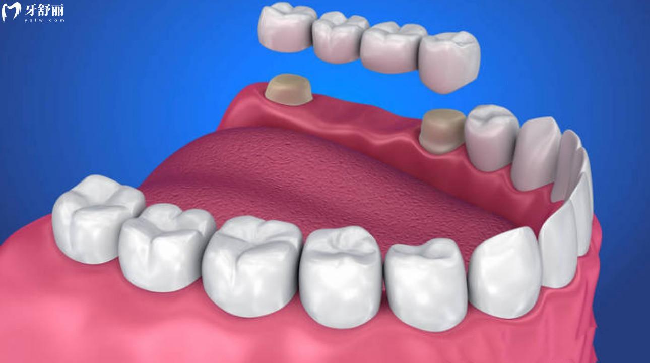 粘结桥牙齿多少钱一颗?粘结桥牙齿优缺点? 粘结桥牙齿多少钱一颗?粘结桥牙齿优缺点?
