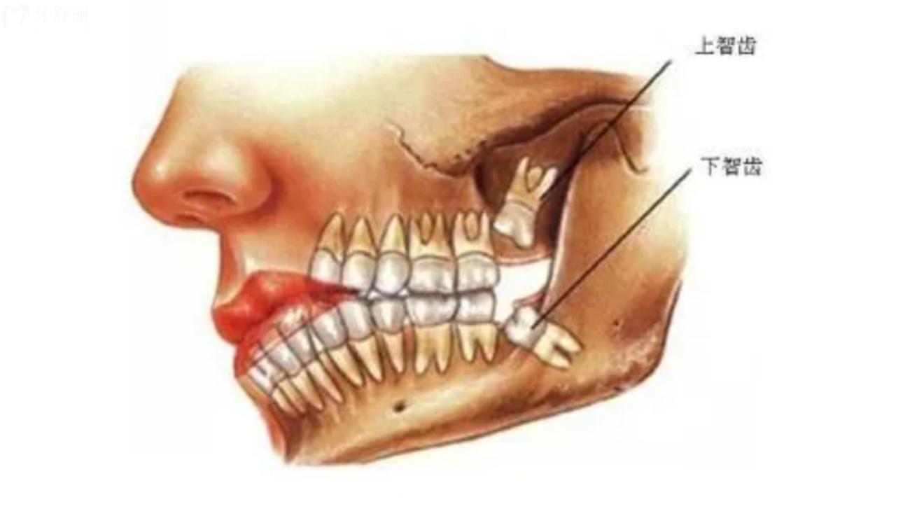 智齿在哪个位置.jpg