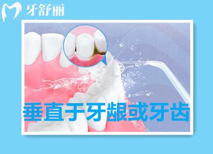戴着牙套如何真正把牙齿清洁干净 几个小方法解决烦恼 戴着牙套如何真正把牙齿清洁干净 几个小方法解决烦恼