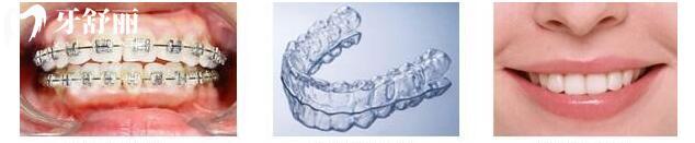 戴着牙套如何真正把牙齿清洁干净 几个小方法解决烦恼 戴着牙套如何真正把牙齿清洁干净 几个小方法解决烦恼