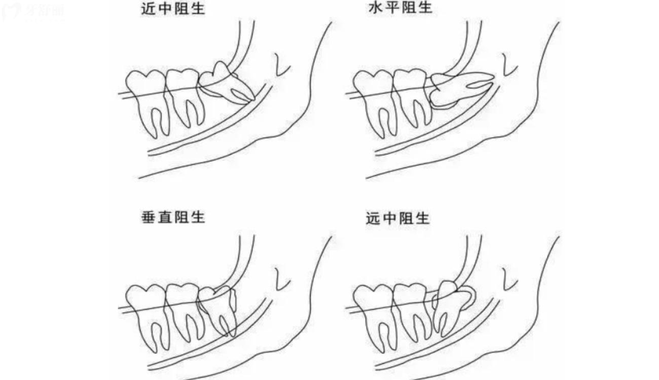 智齿不拔有什么好处.jpg 智齿不拔有什么好处.jpg