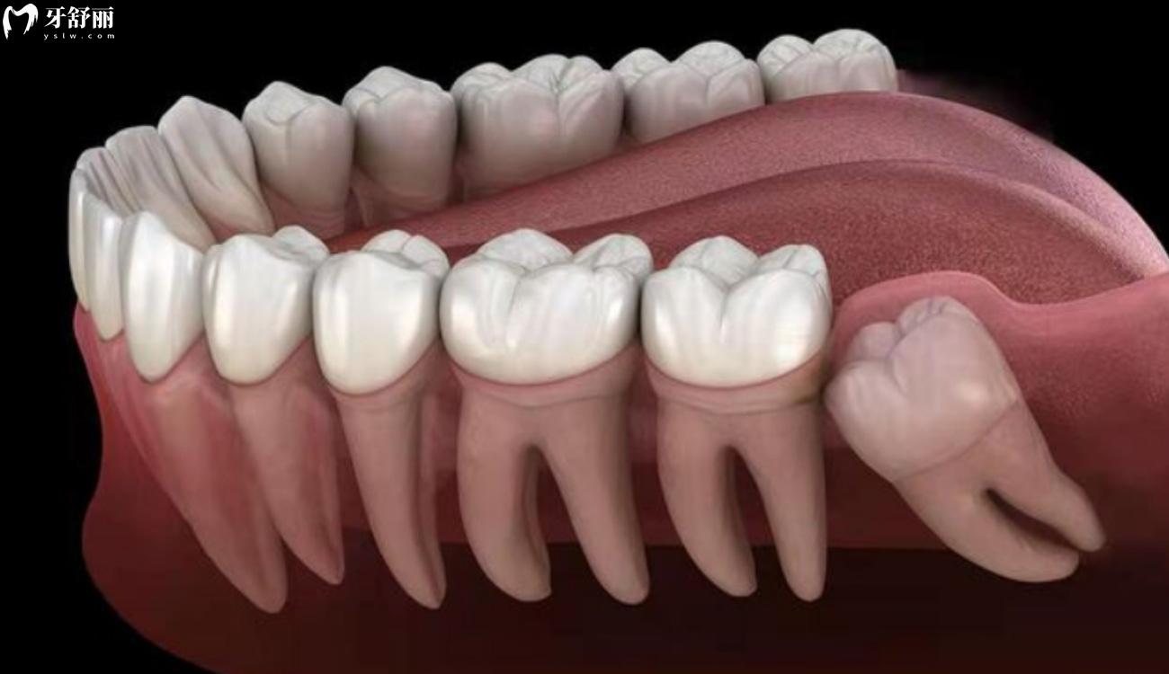 智齿不拔有什么好处.jpg 智齿不拔有什么好处.jpg