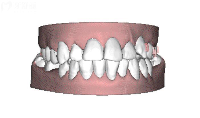 牙齿矫正多大年龄不能做了 牙齿矫正多大年龄不能做了