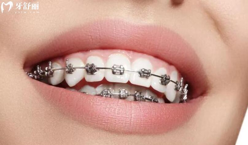 牙齿矫正多大年龄不能做了 牙齿矫正多大年龄不能做了