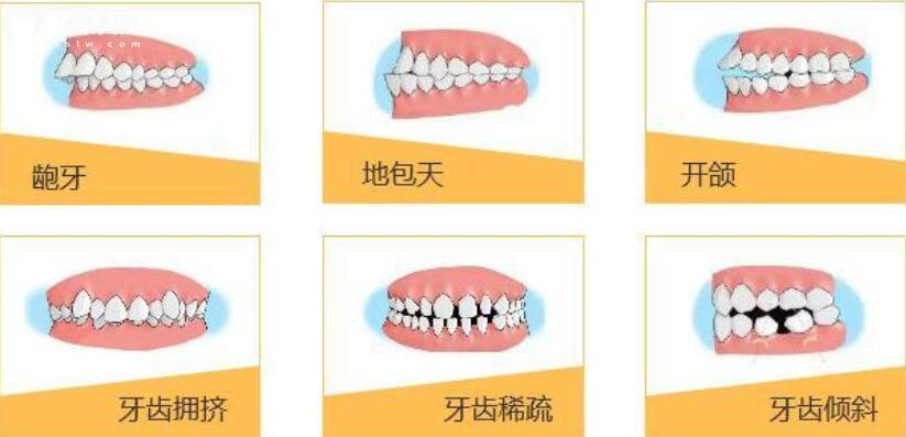 牙齿矫正多大年龄不能做了 牙齿矫正多大年龄不能做了