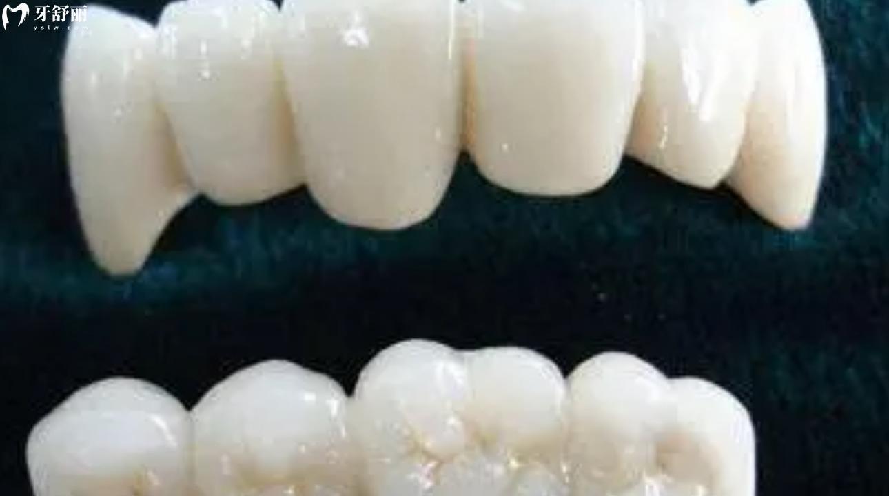 做了没几年的烤瓷牙突然很疼怎么办 烤瓷牙怎么安装上去的 做了没几年的烤瓷牙突然很疼怎么办 烤瓷牙怎么安装上去的