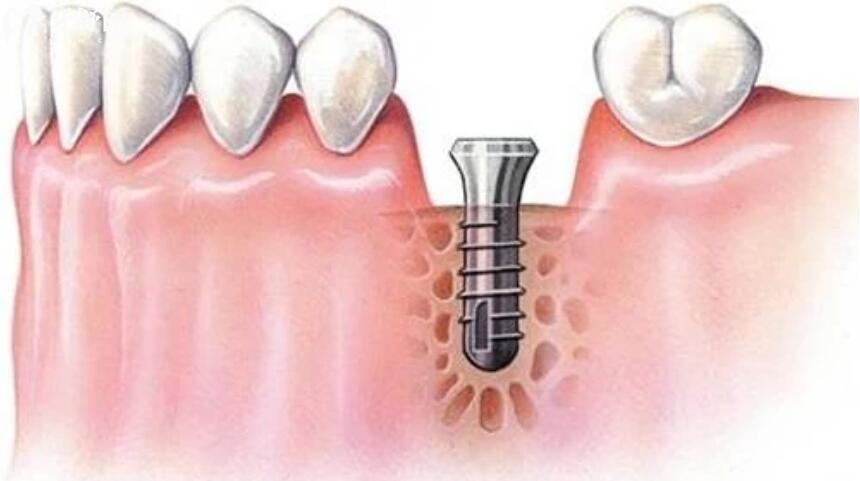 种植牙有年龄限制吗 种植牙有年龄限制吗
