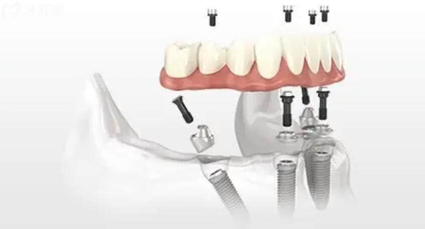 种植牙有年龄限制吗 种植牙有年龄限制吗
