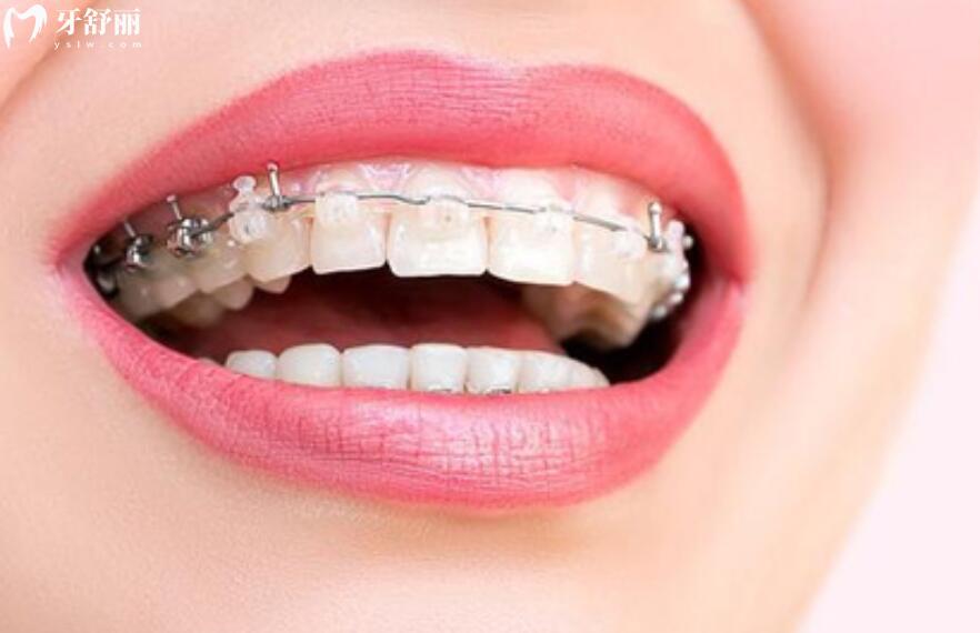牙齿矫正的方法有哪些