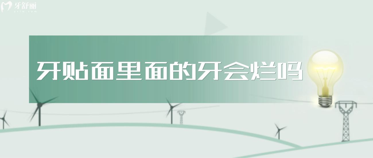 牙贴面里面的牙会烂吗.jpg 牙贴面里面的牙会烂吗.jpg