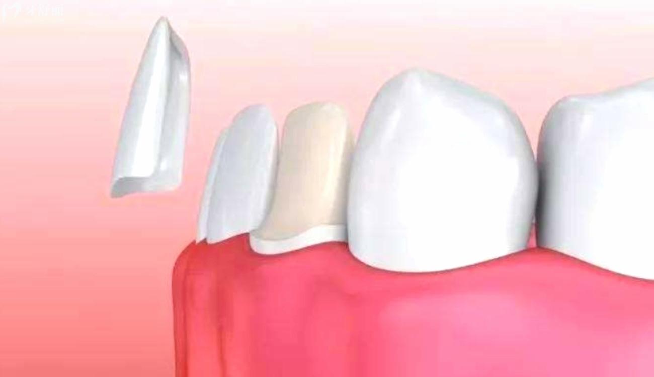 牙贴面里面的牙会烂吗.jpg 牙贴面里面的牙会烂吗.jpg