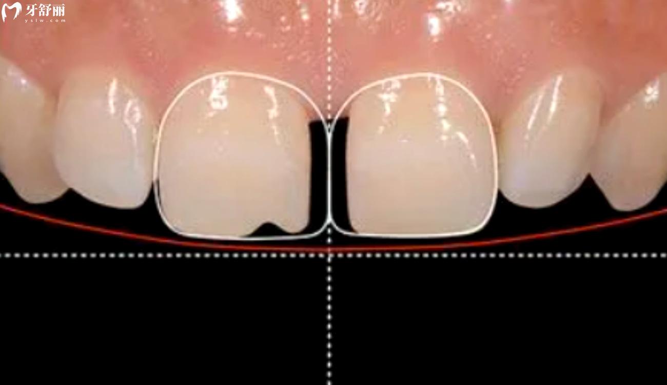 牙贴面里面的牙会烂吗.jpg 牙贴面里面的牙会烂吗.jpg
