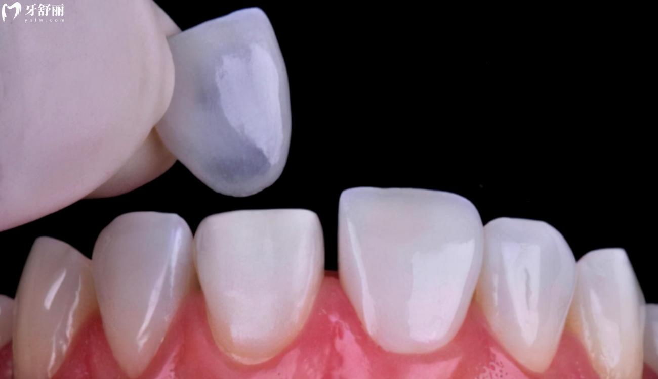 牙贴面里面的牙会烂吗.jpg 牙贴面里面的牙会烂吗.jpg