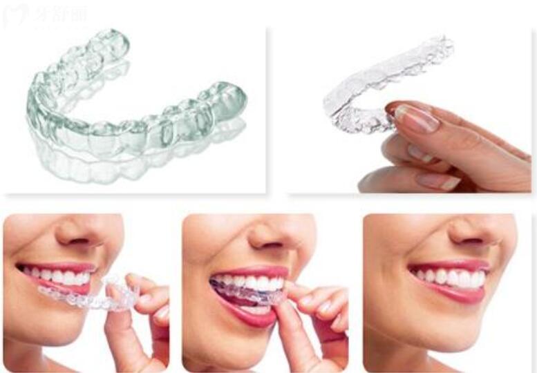 做牙齿矫正需要拔牙吗 做牙齿矫正需要拔牙吗