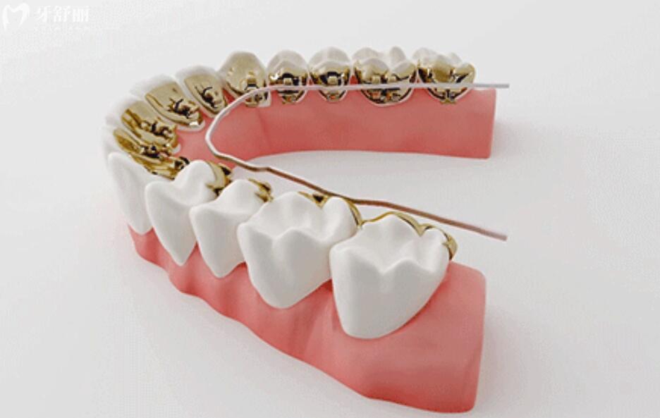 做牙齿矫正需要拔牙吗 做牙齿矫正需要拔牙吗