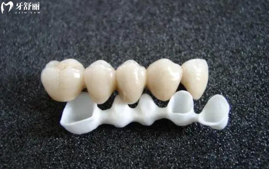 做牙齿美容冠要多少钱 做牙齿美容冠要多少钱