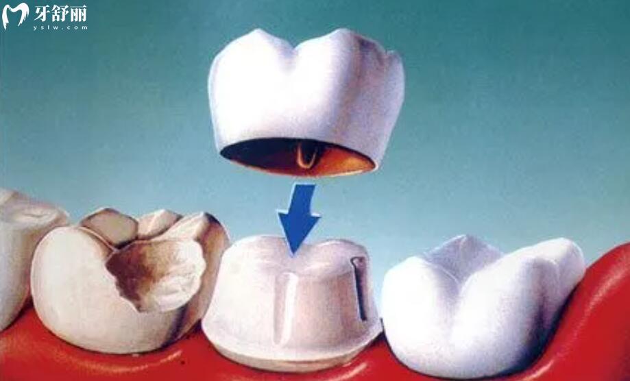 做牙齿美容冠要多少钱 做牙齿美容冠要多少钱