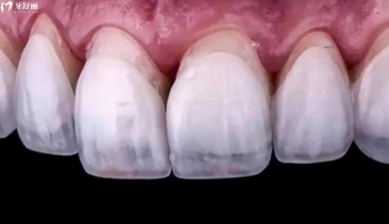 牙齿贴面取下来牙就废了吗.jpg 牙齿贴面取下来牙就废了吗.jpg