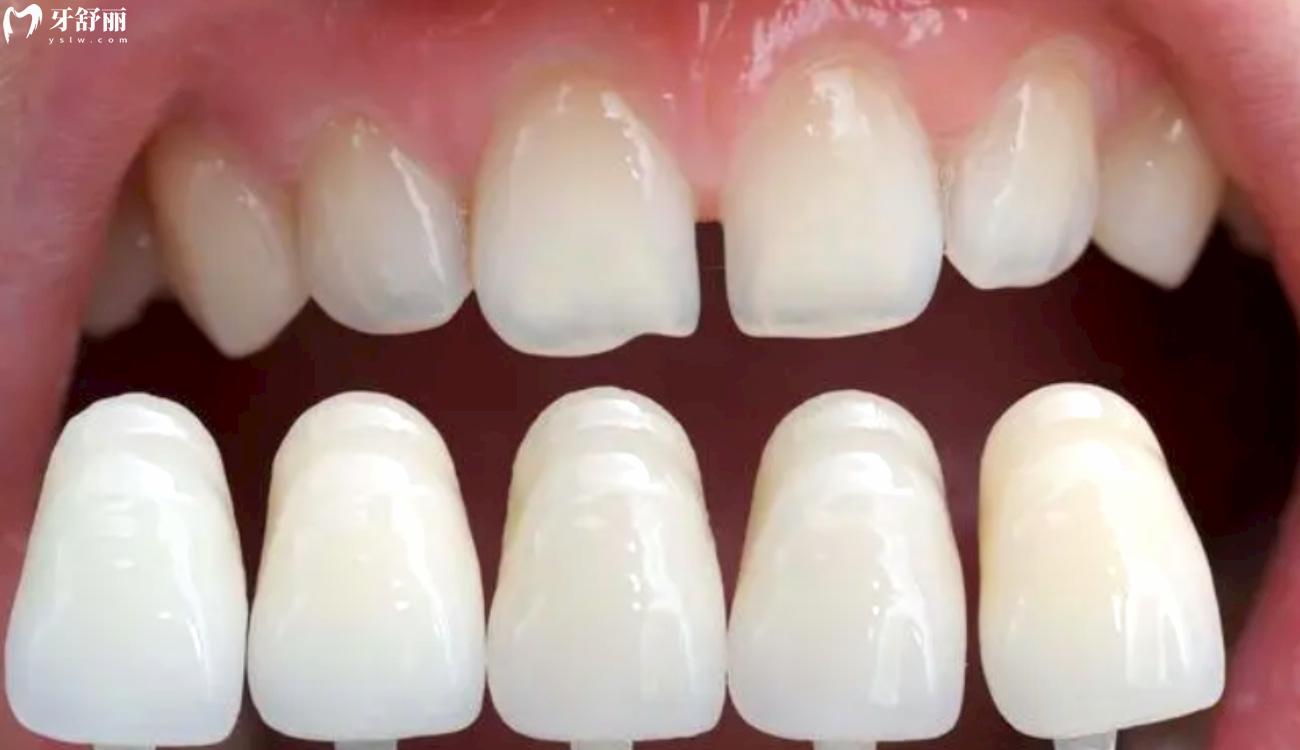 牙齿贴面取下来牙就废了吗.jpg 牙齿贴面取下来牙就废了吗.jpg