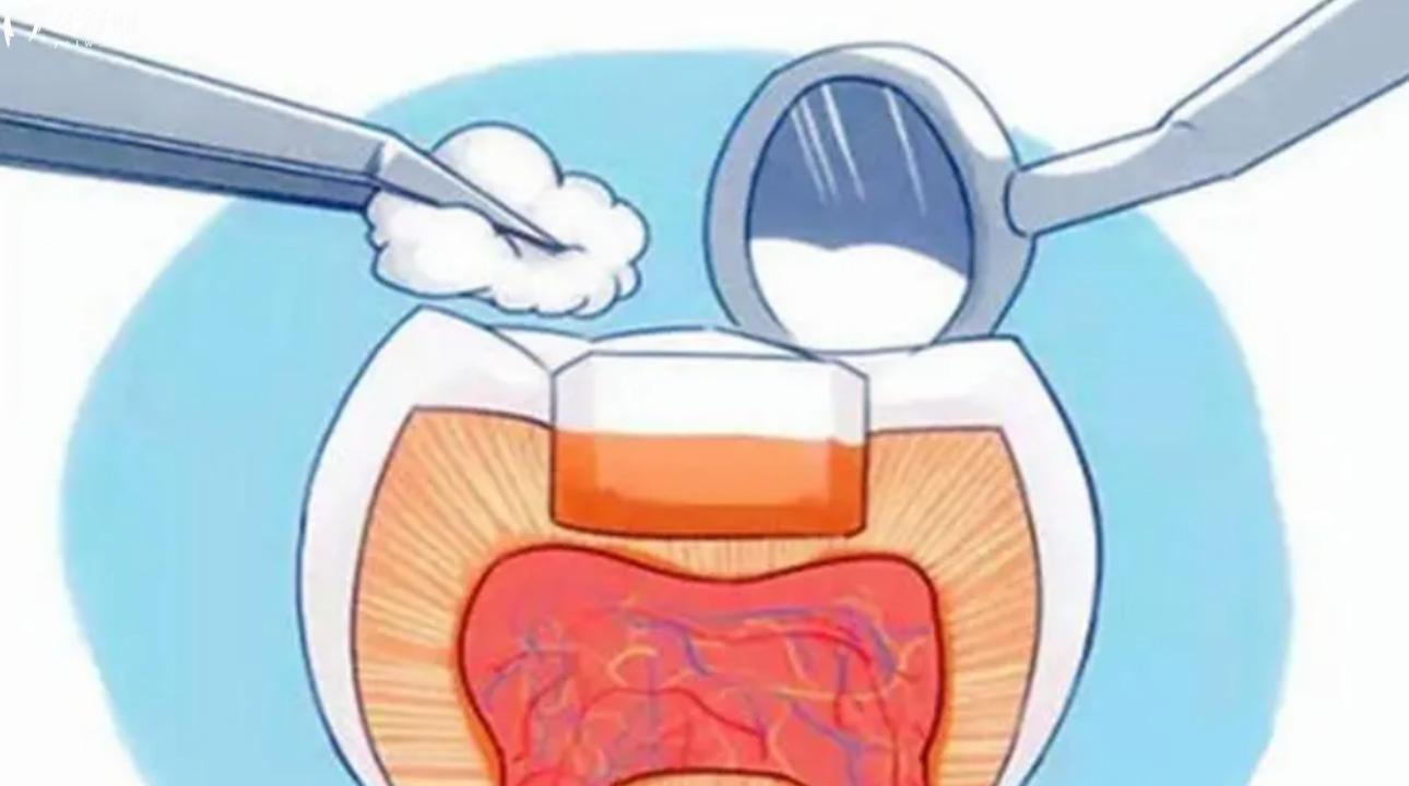 登泰克树脂补牙多少钱?登泰克树脂与美国科尔哪个好 登泰克树脂补牙多少钱?登泰克树脂与美国科尔哪个好