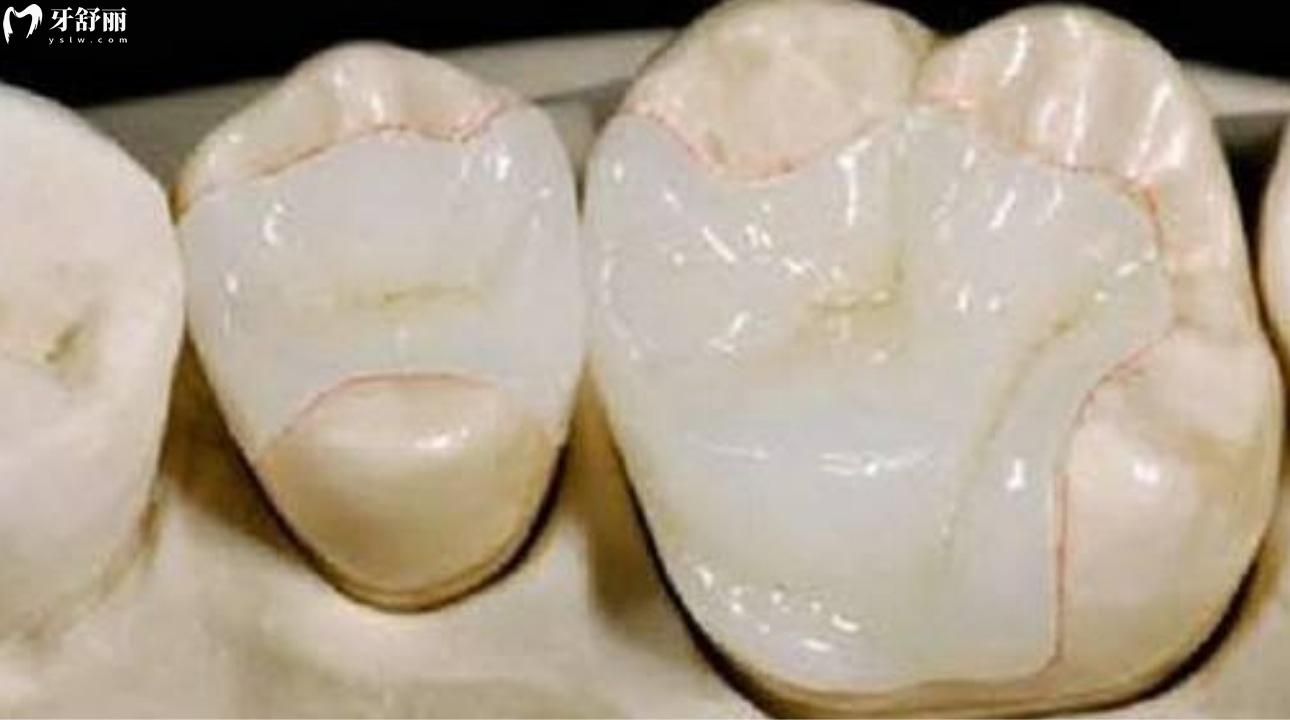 登泰克树脂补牙多少钱?登泰克树脂与美国科尔哪个好 登泰克树脂补牙多少钱?登泰克树脂与美国科尔哪个好