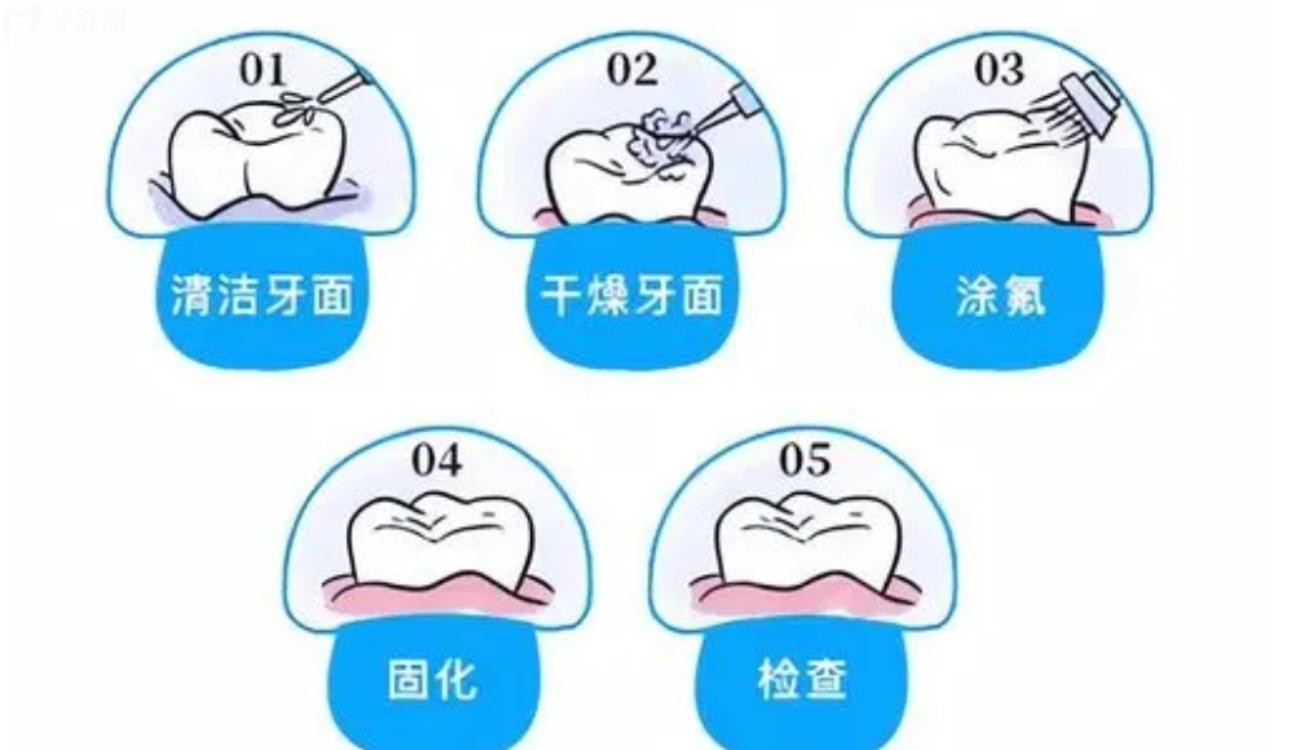 小孩的牙齿涂氟注意事项.jpg 小孩的牙齿涂氟注意事项.jpg