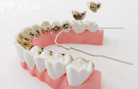 辟谣传闻中的正畸误区 但你解开牙齿矫正的真相 辟谣传闻中的正畸误区 但你解开牙齿矫正的真相