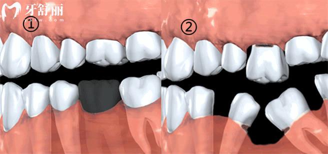 为什么缺牙一定要去做镶牙 看完这些原因你就明白了 为什么缺牙一定要去做镶牙 看完这些原因你就明白了