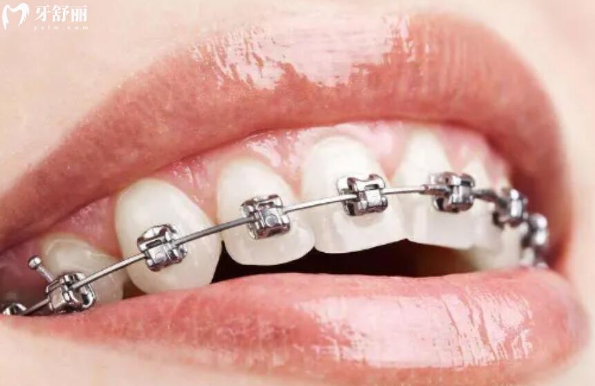 做牙齿矫正多少钱 做牙齿矫正多少钱