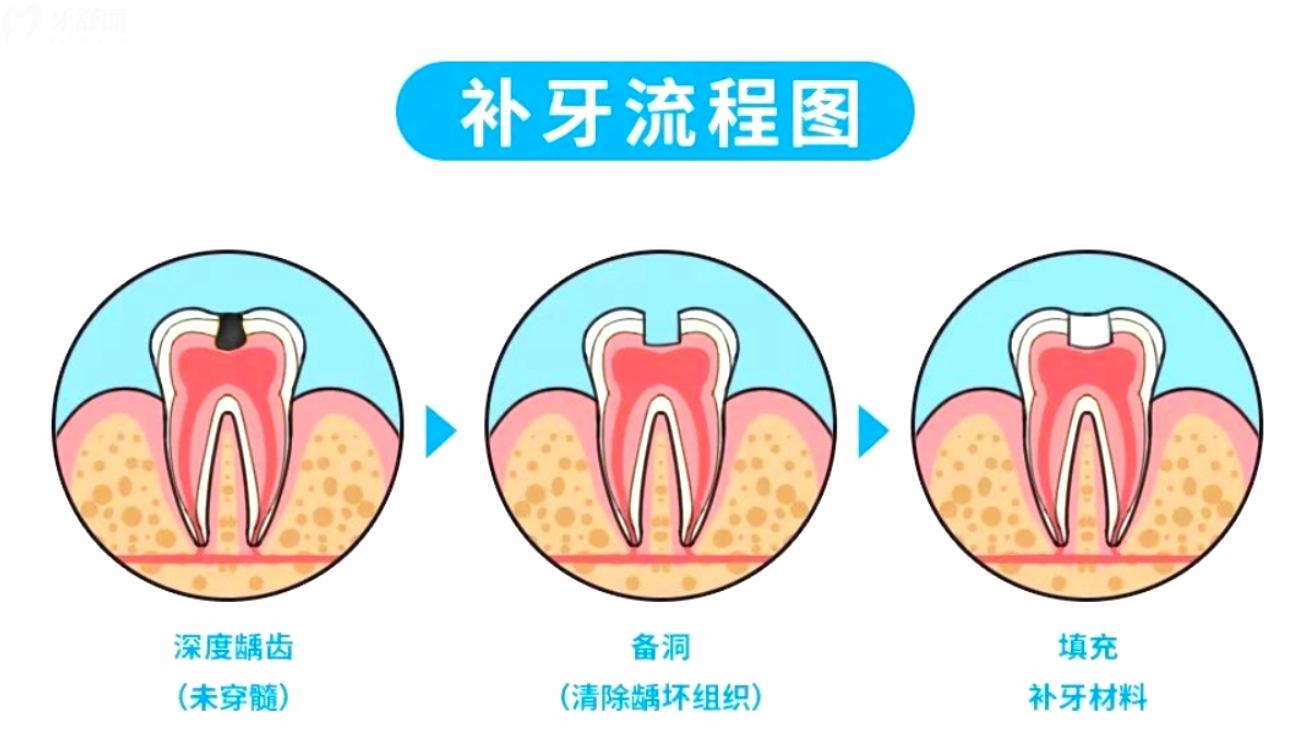 5岁蛀牙洞千万不能补是真的吗.jpg 5岁蛀牙洞千万不能补是真的吗.jpg