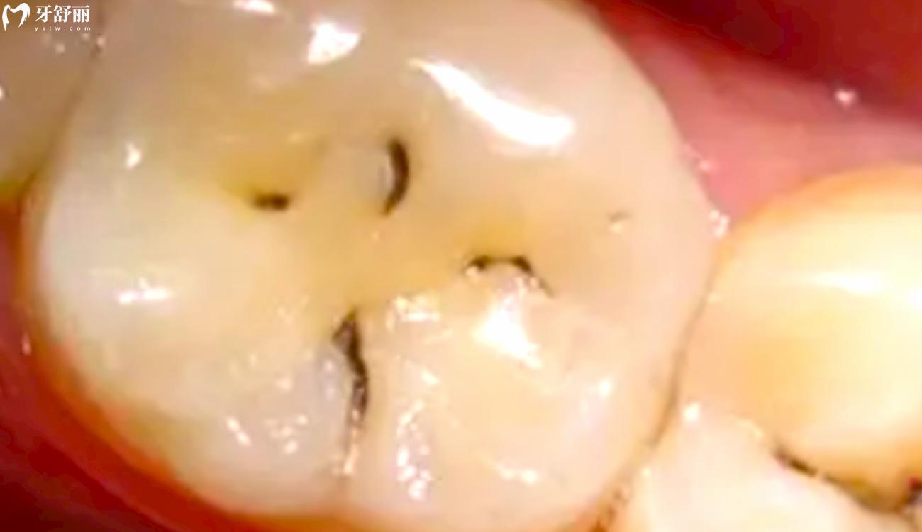 5岁蛀牙洞千万不能补是真的吗.jpg 5岁蛀牙洞千万不能补是真的吗.jpg