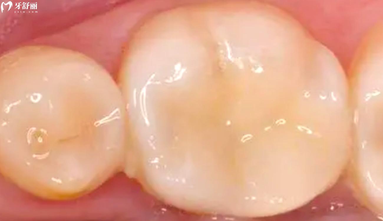 5岁蛀牙洞千万不能补是真的吗.jpg 5岁蛀牙洞千万不能补是真的吗.jpg